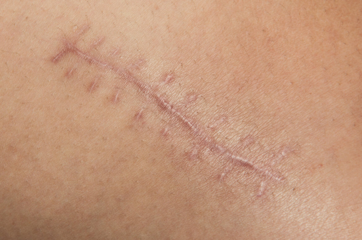 Scarring After Liposuction: Expectations and Tips for Treating Them